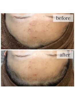 アウラ(AURA)/ハーブピーリング before/after