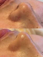 ミピブ 梅田(mipibu)/プラズマ毛穴、ニキビケア