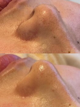 ミピブ 梅田(mipibu)/プラズマ毛穴、ニキビケア