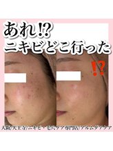 アルムダアクア 天王寺店(Aleumda AQUA)/ハーブピーリング/大阪/天王寺