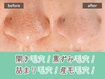 キザシ(kizashi)/最新毛穴ケア☆即実感！毛穴縮小