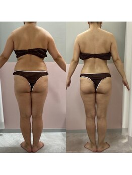 エクラ(Eclat)/Eclatの痩身★BeforeAfter2