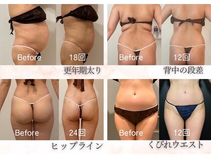 ビューティーワンド ココ(Beauty Wand COCO)の写真