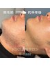 【青ヒゲ卒業|男性施術】メンズヒゲ脱毛 ¥5,000→¥3,900