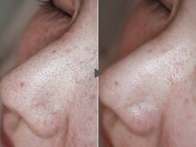 クリード(CLEAD)/ハイドラフェイシャル/毛穴洗浄