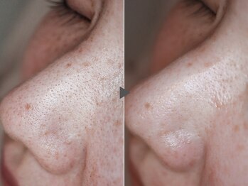 クリード(CLEAD)/ハイドラフェイシャル/毛穴洗浄