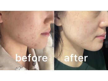 ビーアンドビー(B&B)/エクソソーム美肌コース