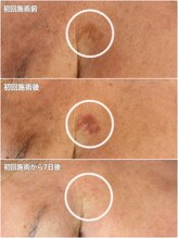 サロン マリー(SALON MARIE)/日本初！連射式光フェイシャル♪