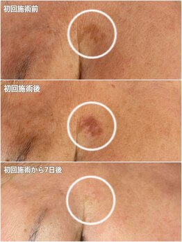 サロン マリー(SALON MARIE)/日本初！連射式光フェイシャル♪