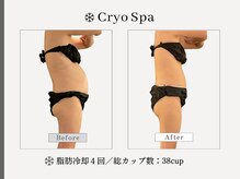 クリオスパ 豊春店(Cryo Spa)/脂肪冷却Before/After