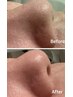 毛穴吸引でさくっと毛穴ケア！※オプションメニューになります。