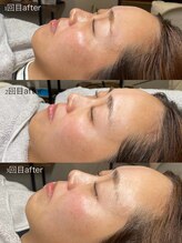 フーフラット(Huu flat)/フェイシャルワックス