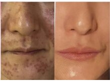 マシェリ(Ma che'rie)/諦めていたシミ改善♪