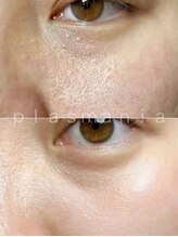 ウルリア(URURIA)/プラズマニア 毛穴改善症例