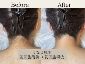 インベスト(INVEST)/うなじ脱毛