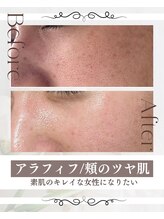 ピュアル 川口(Pual)/【毛穴レス/毛穴開き/シミ】