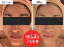 アクア(akua....)/施術10回★シミ改善顔のトーンUP