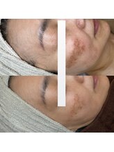 エヴェリーナ(Eveliiina)/極上シミケアコース　４０代