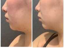 AI肌管理サロン レアリス【4月1日NEW OPEN】/RF(ラジオ波) たるみケア