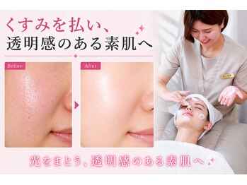 メモリの写真/毛穴洗浄でくすみを取り除く!!紫外線で焼けた黒ずみ/日焼け肌に効果あり◎今まで改善しなかった方もお任せ!