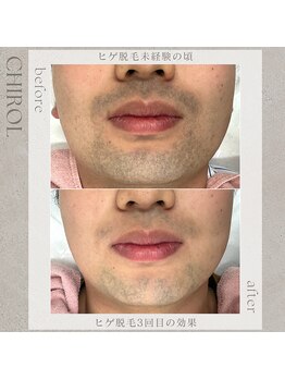 チロル(CHIROL)/ヒゲ脱毛3回目
