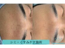 リメイクビューティークリニック(REMAKE BEAUTY CLINIC)/１回：乾燥肌改善