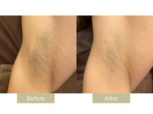 リフサロ(Rifsaro)/メンズワキ脱毛