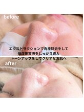 サロン ザ プマロ(SalonThePumalo)/毛穴の黒ずみ、開きにお悩み