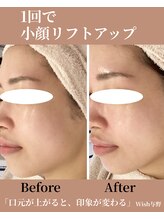 ウィッシュ 与野(Wish)/口元リフト 印象アップ