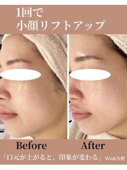 ウィッシュ 与野(Wish)/口元リフト 印象アップ