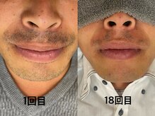 ふぁみーゆ(famille)/メンズヒゲ脱毛！