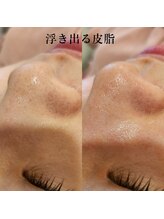レイネイル レイエステティック 岐阜茜部店(RAY NAIL & RAY ESTHETIC)/浮き出る皮脂