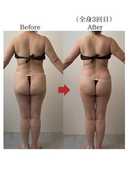 バーチュ(Virtue)/全身3回で隙間が！！