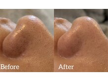 アリビオ(ALIVIO)/毛穴エクストラクション☆