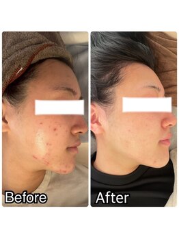 ドクター小顔 銀座店(Dr.小顔)/ニキビケア・赤み肌・毛穴