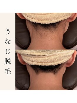 ミウ(MIU)/【 うなじ脱毛 】