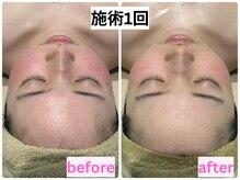 アドミーロ/国産ハーブ純度100%1回