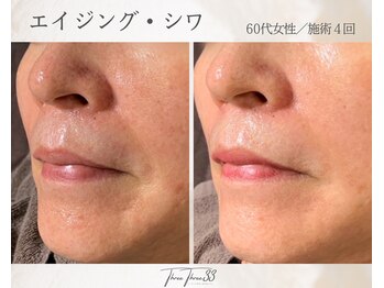 スリースリー(THREE THREE)/エイジング・しわケア