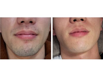 セブンボーテ(7Beaut'e)/ひげ脱毛♪