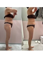 エクラ(Eclat)/Eclatの痩身★BeforeAfter3