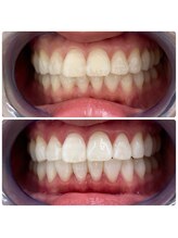 コナホワイトニング 神保町/ホワイトニング