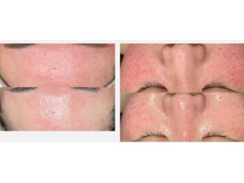 サロンド エステ ミニョン(salon de esthe mignon)/ラミネーションピール