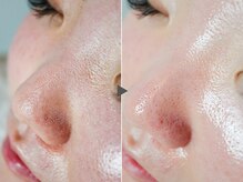 クリード(CLEAD)/毛穴洗浄☆ハイドラフェイシャル