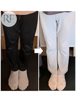 リベスト(RE:BEST)/当院の<骨盤+O脚矯正>効果