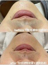 マドンナリリー 恵比寿店(Madonna Lily)/ハイパワー脱毛の効果♪