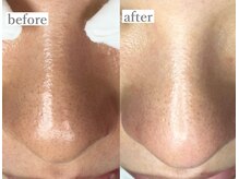 ライカブルー(RaicA BluE)/施術写真　before-after