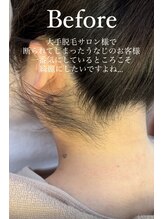 エリス(ELISSE)/ワックスと光脱毛のダブル効果