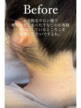 エリス(ELISSE)/ワックスと光脱毛のダブル効果