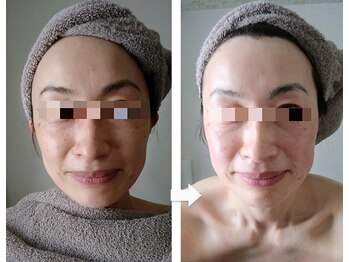 サラサ(SARASA)/シミケア・小顔ケア