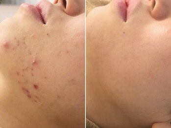 ハダイ(HADAY)/ニキビ改善｜ハーブピーリング